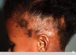 Why Do Kids Get Alopecia? Understanding the Causes and Factors